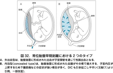 胎盤剝離後期|常位胎盤早期剥離とは？なりやすい人の特徴・予防法。